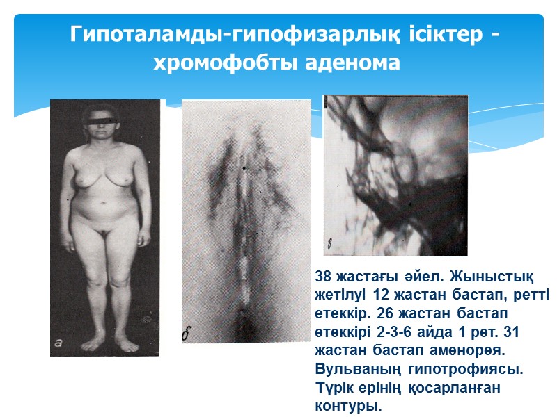 Гипоталамды-гипофизарлық ісіктер - хромофобты аденома 38 жастағы әйел. Жыныстық жетілуі 12 жастан бастап, ретті